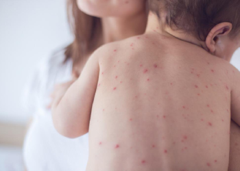 Phân biệt sởi và thủy đậu chi tiết - Thời Báo Việt