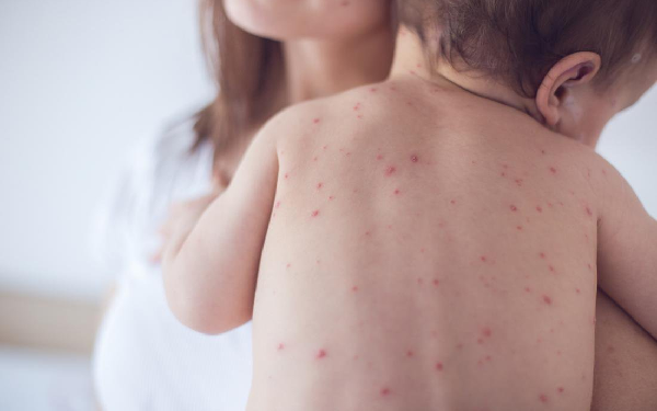 Phân biệt sởi và thủy đậu chi tiết - Thời Báo Việt