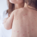 Phân biệt sởi và thủy đậu chi tiết - Thời Báo Việt