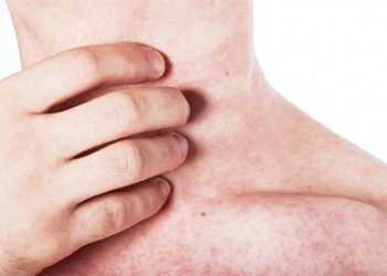 Dấu hiệu bệnh sởi ở người lớn thường gặp - Thời Báo Việt