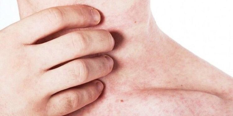Dấu hiệu bệnh sởi ở người lớn thường gặp - Thời Báo Việt