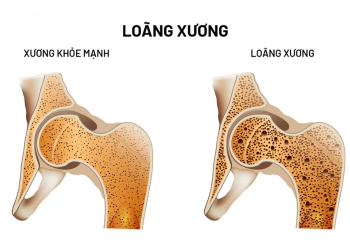 Người bệnh loãng xương nên uống sữa gì? - Thời Báo Việt