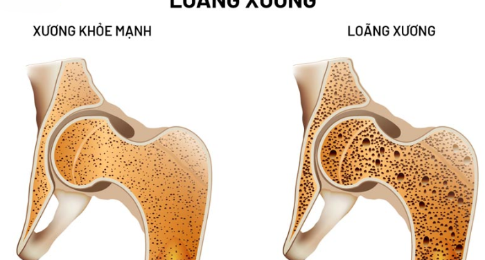 Người bệnh loãng xương nên uống sữa gì? - Thời Báo Việt