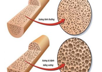 Bật mí top 5 sữa loãng xương cho người lớn tuổi tốt nhất trên thị trường - Thời Báo Việt