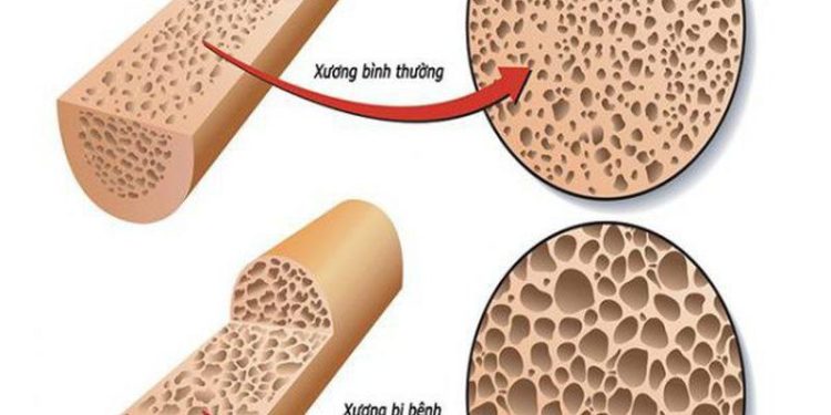 Bật mí top 5 sữa loãng xương cho người lớn tuổi tốt nhất trên thị trường - Thời Báo Việt